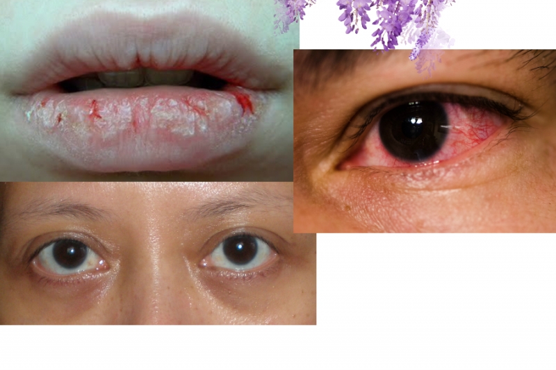 黑眼圈,嘴裂,眼睛血丝代表了