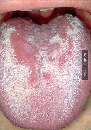 Throat Virus Greenish Mucous 40