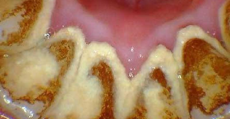 自己在家里就能去除牙结石,「一招」解决大黄牙