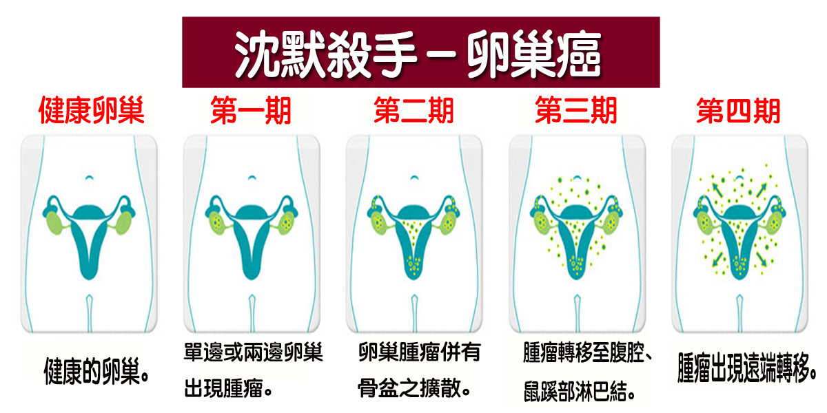 頻尿 腹脹 別輕忽 關於 卵巢癌 的早期四大警訊 不注意恐致命 Love分享