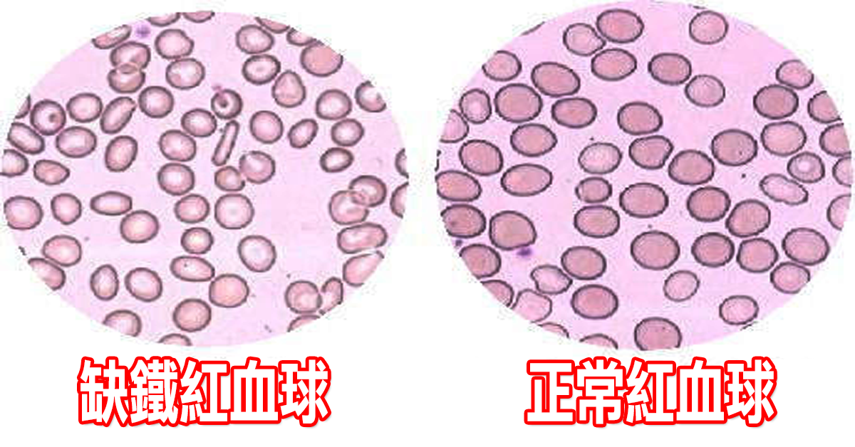 全是「缺铁性贫血」惹的祸:五种「补铁食物」这样吃,远离「贫血人生」