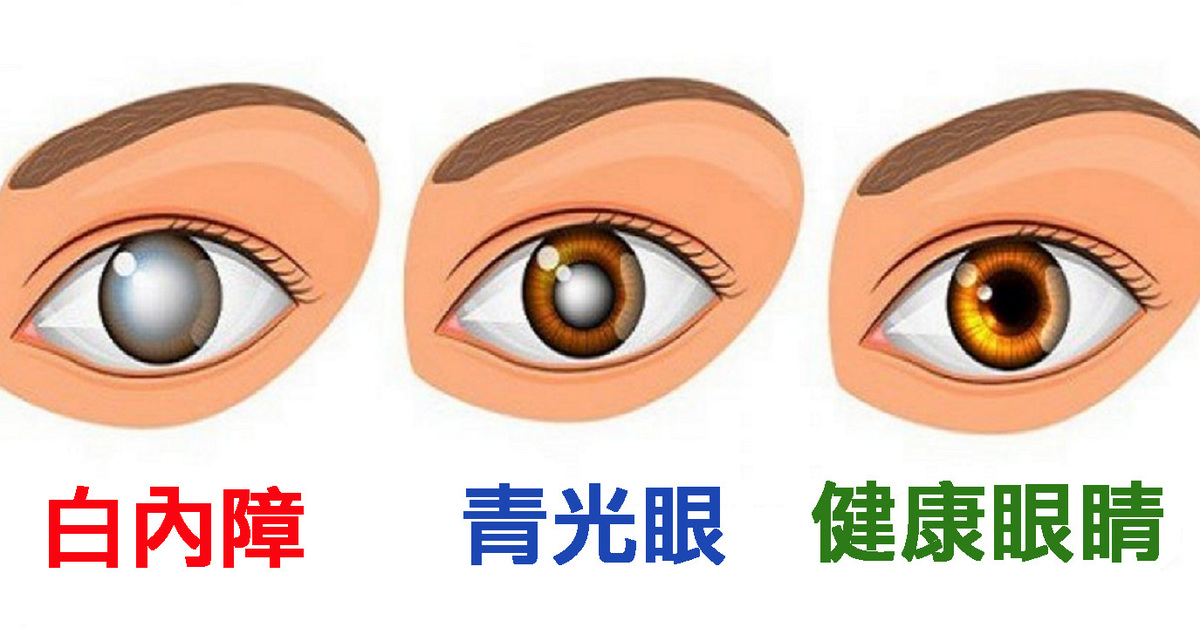近视手术选购指南