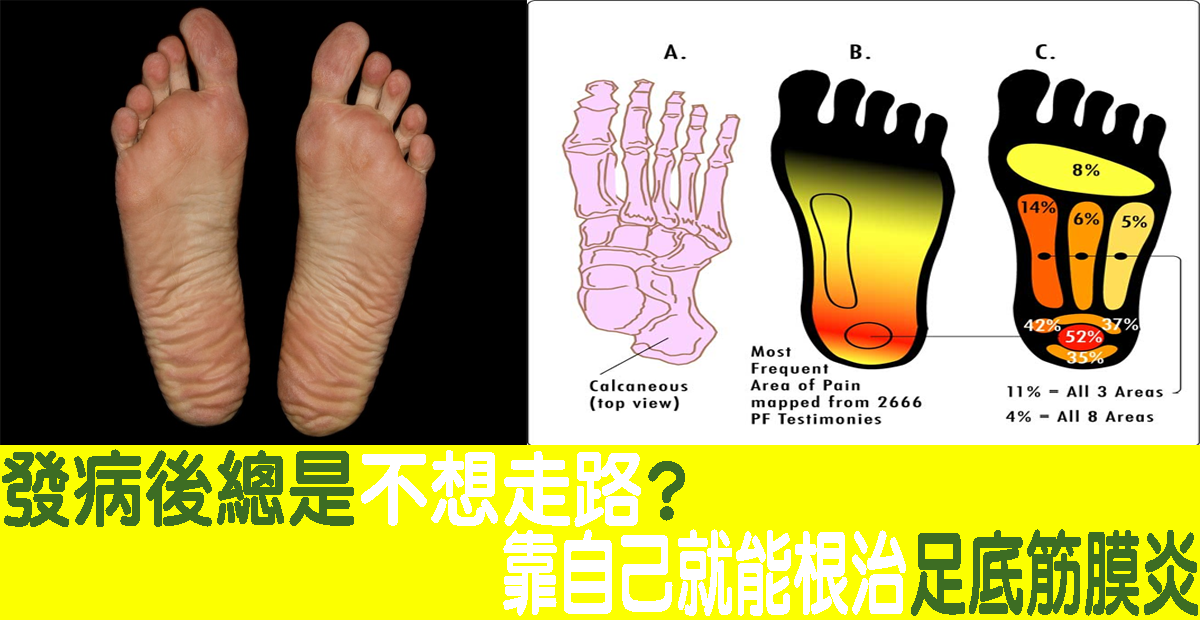 下床走路有如刀山酷刑?靠自己用这「六种方法」痊愈「足底筋膜炎」