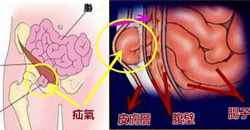 那可能是「疝气」,不痛