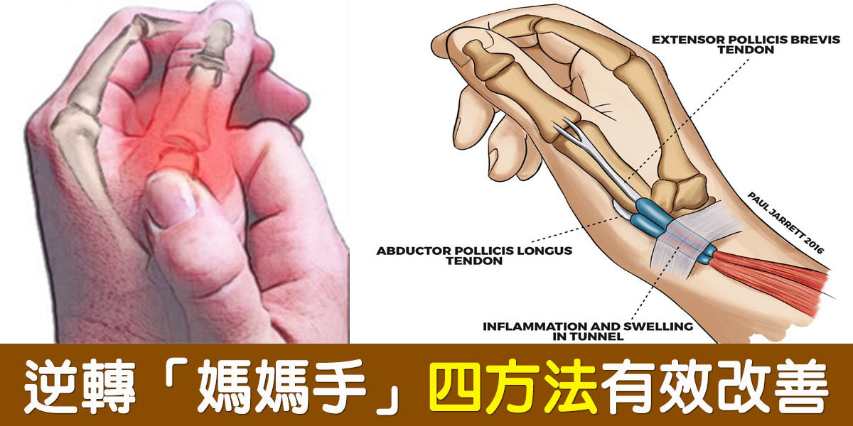 媽媽手」一發作,「手指僵硬、輕微轉動」都會痛?根治「腱鞘炎」只需四