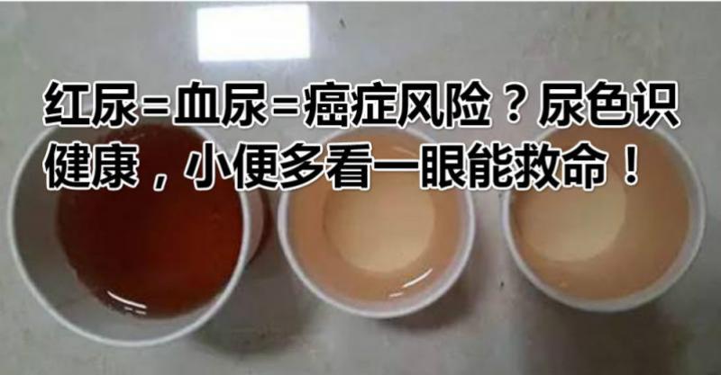 红尿=血尿=癌症风险?尿色识健康,小便多看一眼能救命!