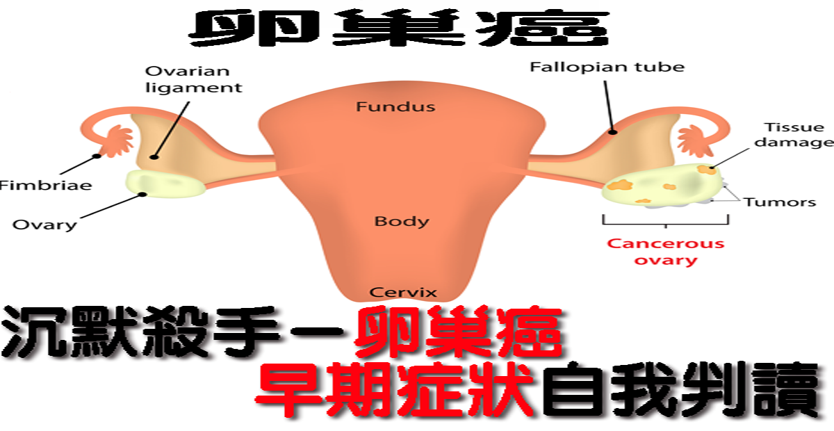 80 的女性發現都已是末期 卵巢癌 首度擠進10大癌 5個 早期症狀 自我檢測 Love分享