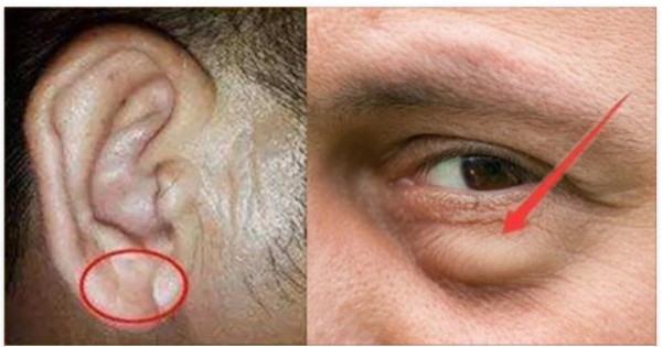专家提醒:6种皱纹,是健康报警,不可忽视,耳垂皱