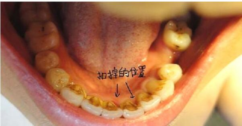 牙齿内侧黄黄的脏东西怎麼去除?