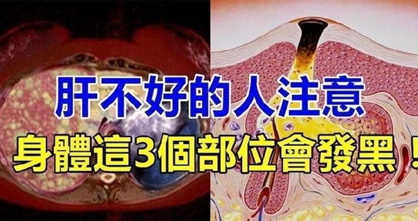 中医警告:肝不好的人,这3个部位会发黑!多吃3种食物,肝越来越好!
