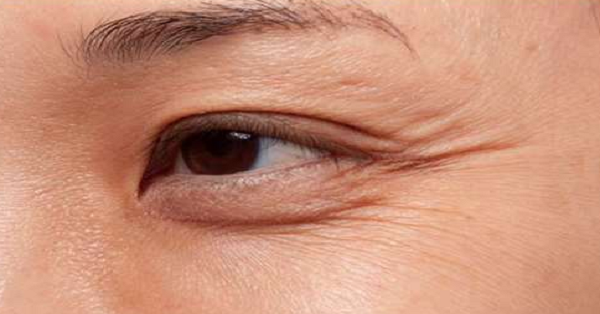 想要消除讨人厌的「鱼尾纹」和「法令纹」吗?