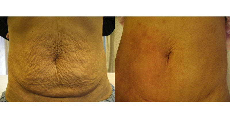 五招有效去除深层妊娠纹!真的很厉害,请告诉妈妈!