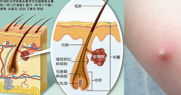 到底什麼是「毛囊炎」?