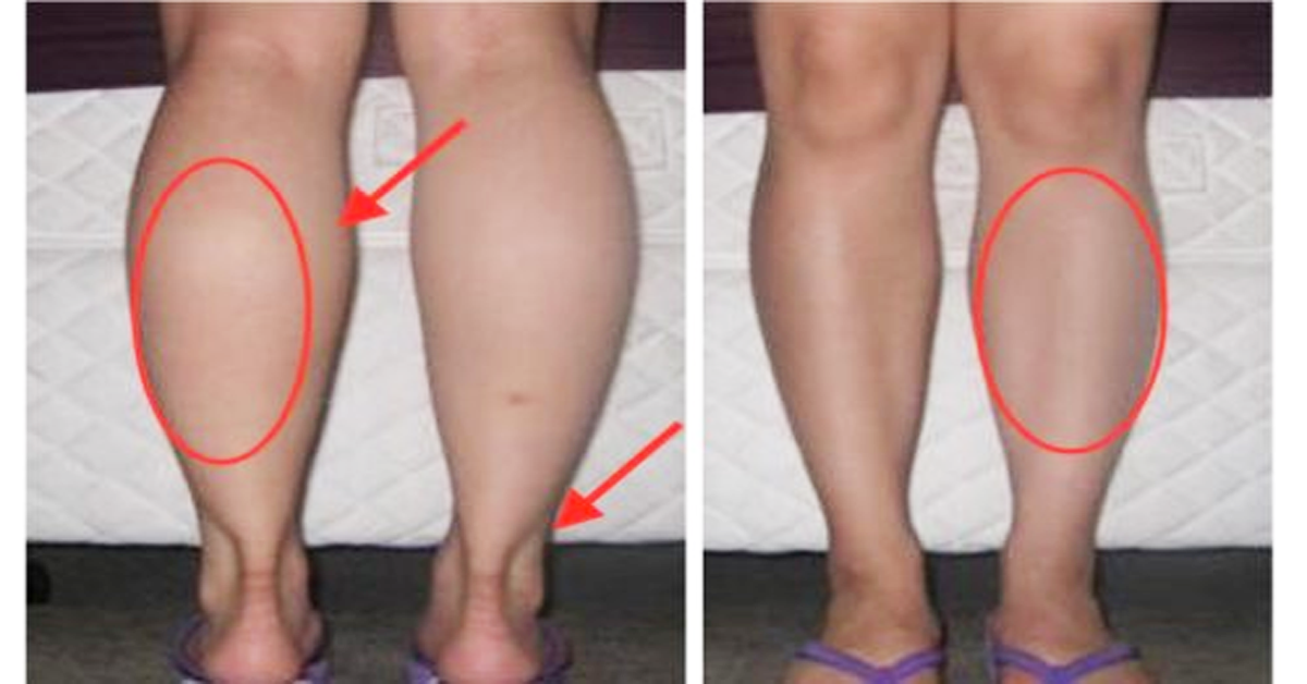 乱运动小心练出粗壮「小腿肌」!「五大诀窍」轻松成就修长美腿
