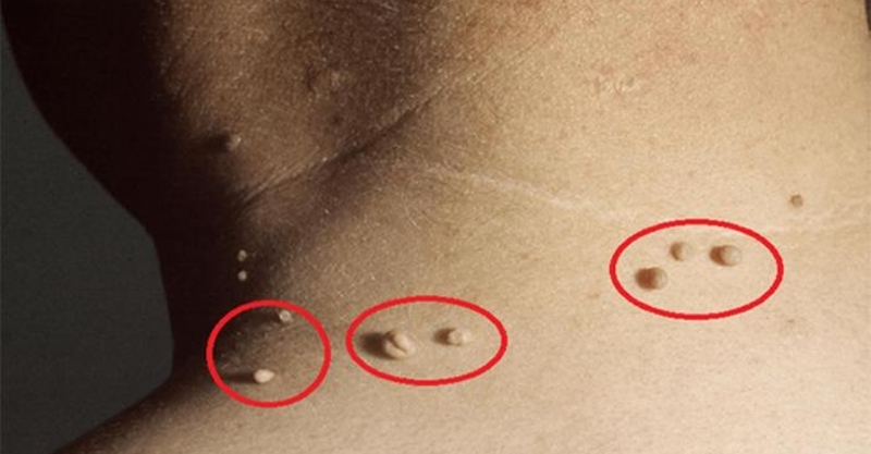 脸上一颗颗的肉瘤终於「有救了」!「这种」天然疗法在家做.