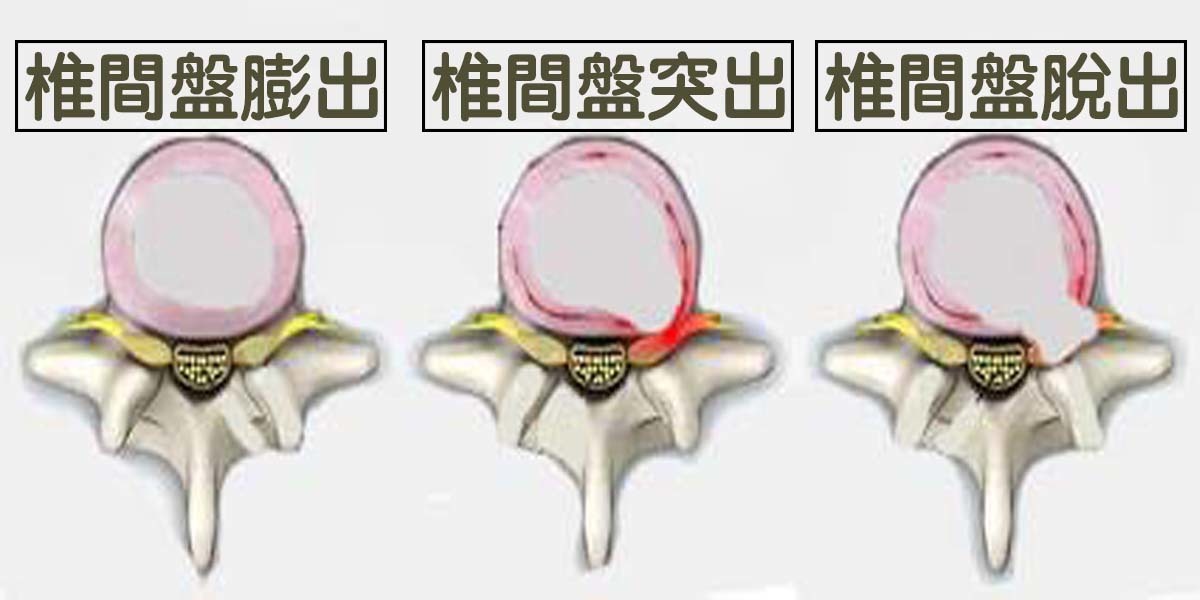 时常「脚麻腰痛,到底是椎间盘「膨出「突出」还是「脱出?