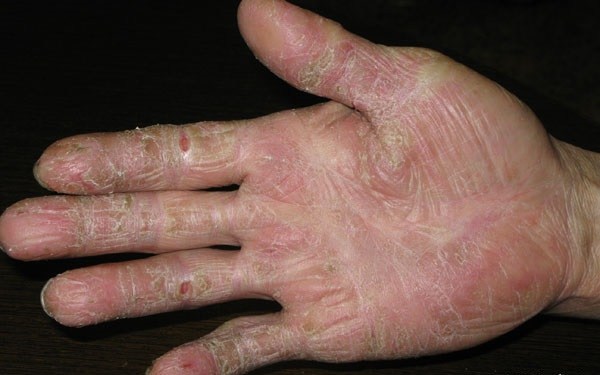 专家提醒:不宜太常洗手!