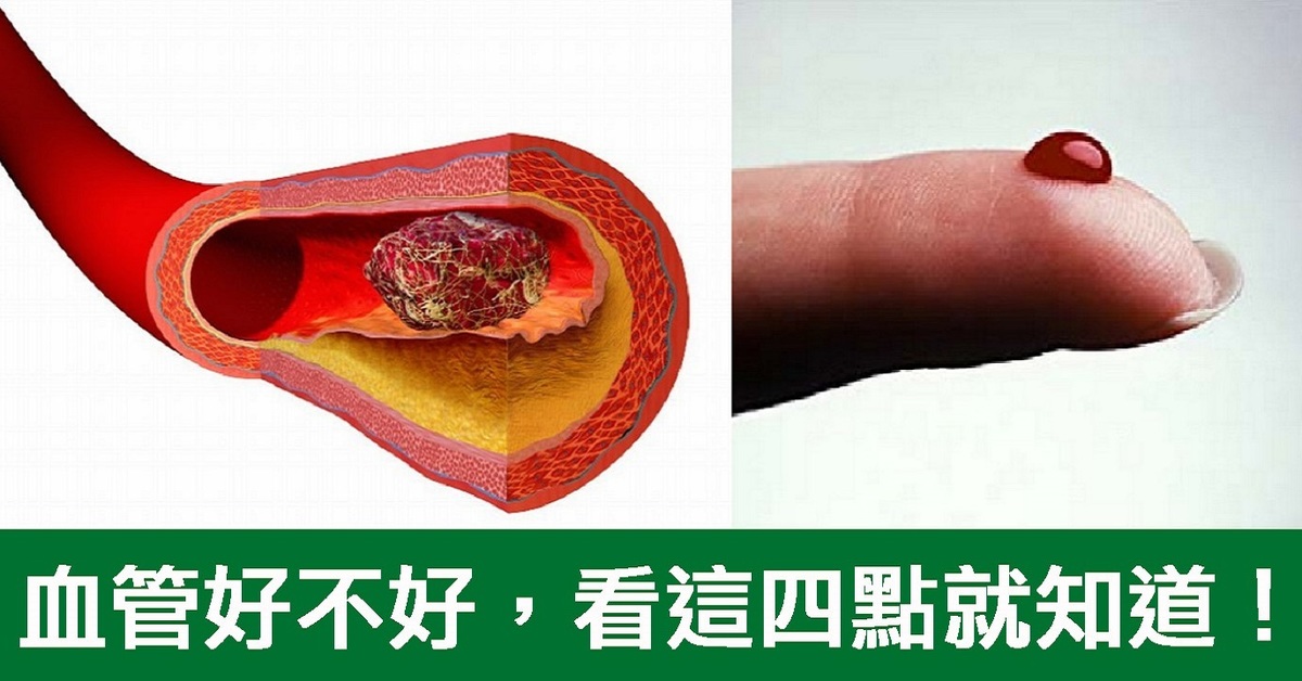 当心「血液」出问题,引发中风,血管硬化!4招自我检测