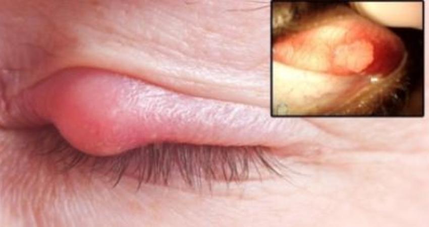 三种方法快速消除「针眼」!这篇收藏好