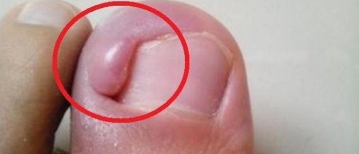 脚趾甲长进肉里怎麼办,不用拔这招能治好