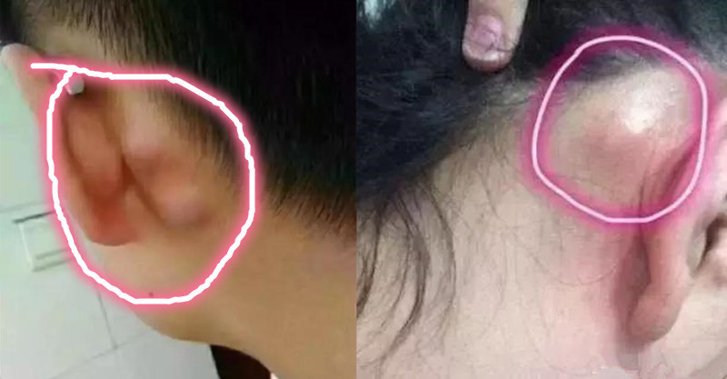 耳后淋巴癌图片 晚期图片