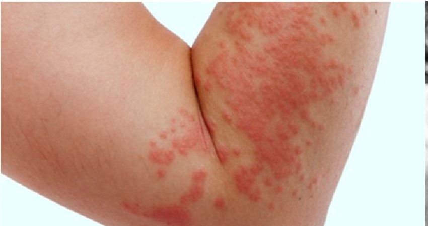「荨麻疹」反覆发作,奇痒无比?
