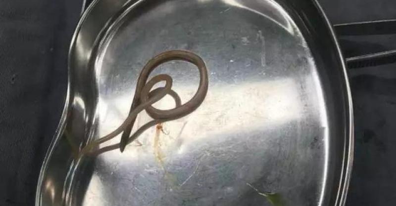 说到蛔虫,一般人总以为是在肠道内,所以当医生告诉69岁的郑阿姨其胆总