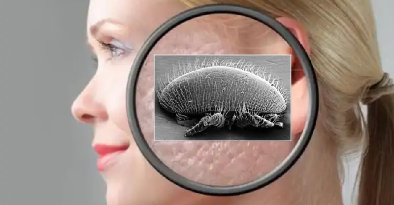 脸上有蟎虫的人,要记住4个「天然除蟎法」,把蟎虫一点一点扼杀