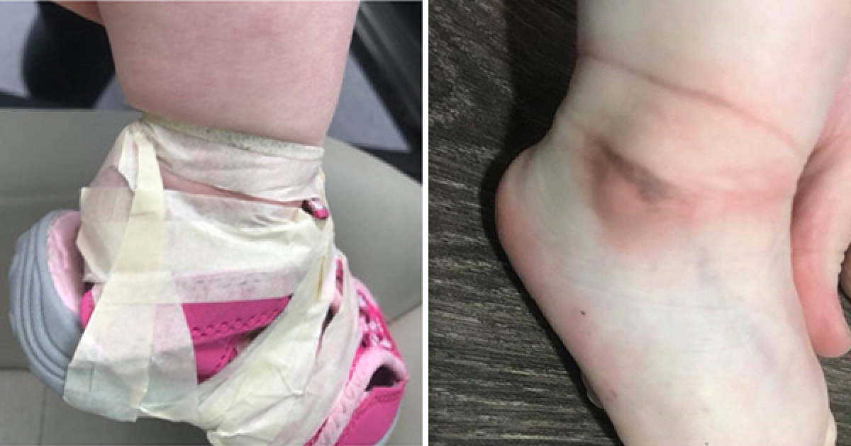 17个月大的女儿时发现,保育员竟然用胶带把女儿的鞋子黏在她的脚踝上