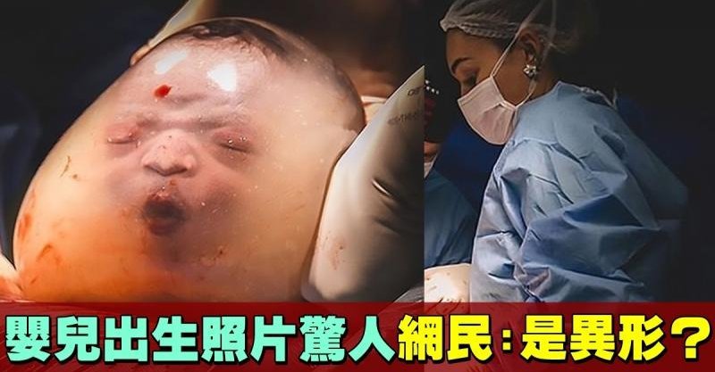 婴儿羊水未破就出生照片惊人 网民以为诞下异形
